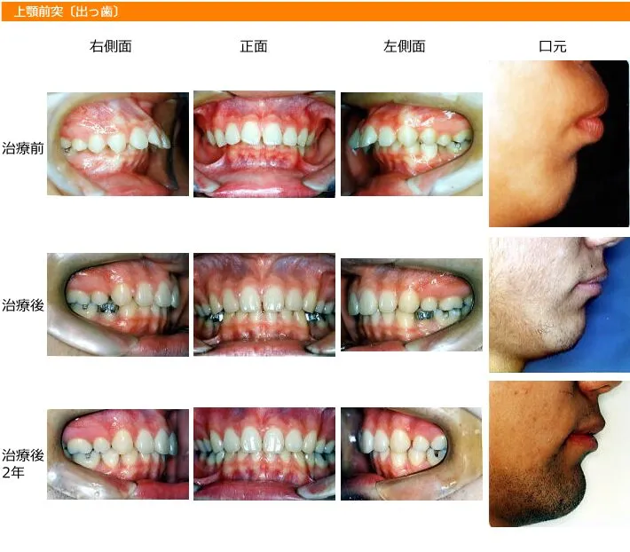 矯正歯科　事例