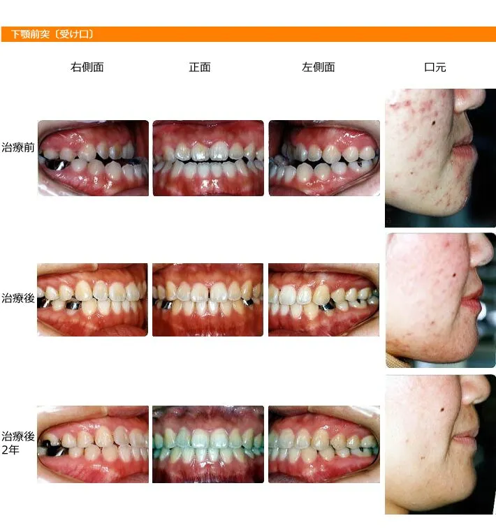 矯正歯科　事例