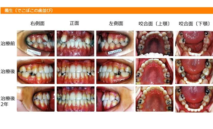 矯正歯科　事例